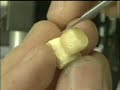 Posterior inlay -Composite build-up procedure