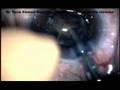 Pupil expansion ring with a single Iris retractor