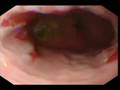 Barrett's esophagus