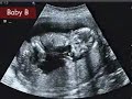 Wilkinson quintuplets ultrasound 3: indentifying gender