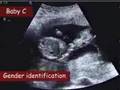 Wilkinson quintuplets ultrasound 3: indentifying gender