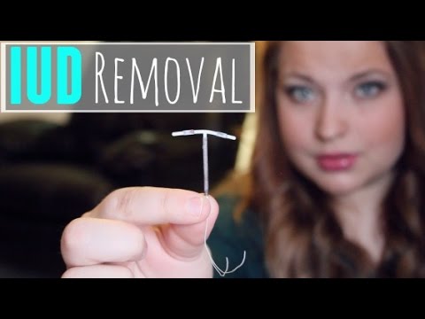 how to remove iud birth control