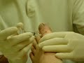 Ingrown Toenail Surgery Part 1