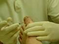 Ingrown Toenail Surgery Part 1