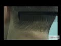 FUE hair restoration of NW3 to NW0 - Dr Umar