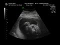 4d ultrasound @ 25 weeks- Part 1/3