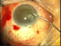 Manual Phaco in trachoma Manual Phaco in trachoma