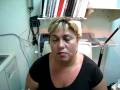 videos de PATIENT WITH VISION LOSS DUE TO MULTIPLE REFRACTIVE SURGICAL PROCEDURES