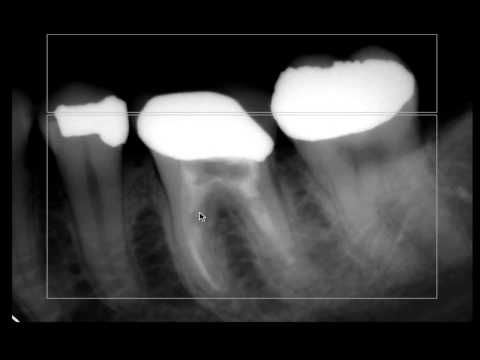 how to treat a periapical and a apex abscess on tooth