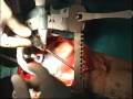 positioning the heart before opcab (normal beating  heart surgery)