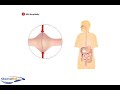 Surgical Treatment of Crohn\ Surgical Treatment of Crohn\