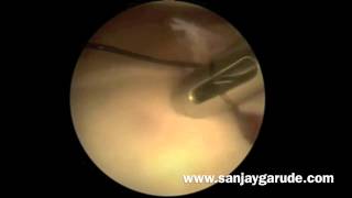 Arthroscopic Bankart repair