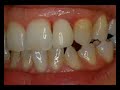 Dental Implant Crown Cementation lateral Incisor Dentalmumbai