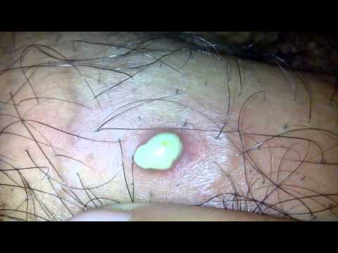 how to draw puss out of a pimple