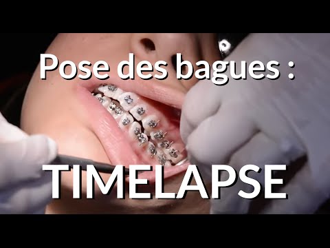 Pose bagues dentaires adulte