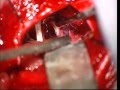 Intervention For Trigeminal Face Neuralgia