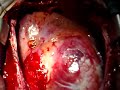 Aneurisma Gigante de Aorta