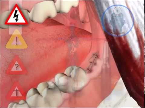 TOOTH!! - Wisdom teeth removal refers to the surgical removal of the third molars, also called 8ers. In expert language, wisdom teeth removal is called R. T. R., or