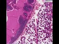 Histopathology Salivary gland--Papillary cystadenoma lymphom Histopathology Salivary gland--Papillary cystadenoma lymphom