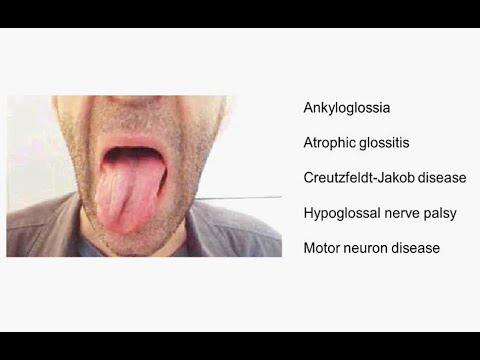 how to treat glossitis