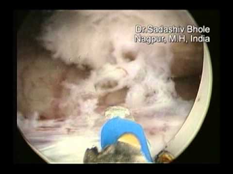 HoLEP by Dr.Sadashiv Bhole on Auriga XL 50