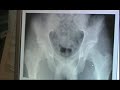 Floyd Landis xrays/mri - interview with his Dr. Floyd Landis xrays/mri - interview with his Dr.