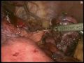 Laparoscopic Correction Of Created With The Open Surgery Gastric Bypass With Roux-En-Y Together With Fundus Resection