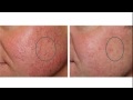 Phoenix Laser Skin Rejuvenation