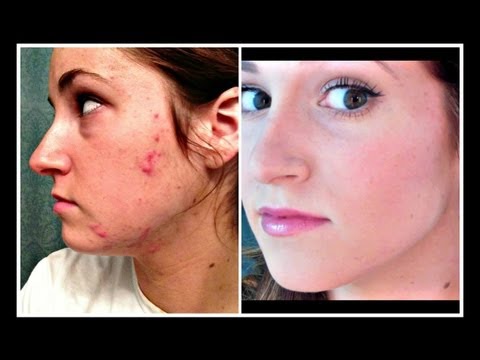 HOW TO | COVER ACNE PRONE SKIN (Foundation Routine)
