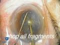 Intraoperative Floppy Iris Syndrome (IFIS) Strategies