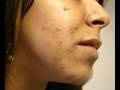 The Acne Practice  (Miracle on 44th street...)