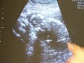 PeaPod Quinton 16 week Ultrasound