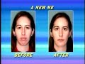 A New Me: Advances in Chin Augmentation with Dr. Kung