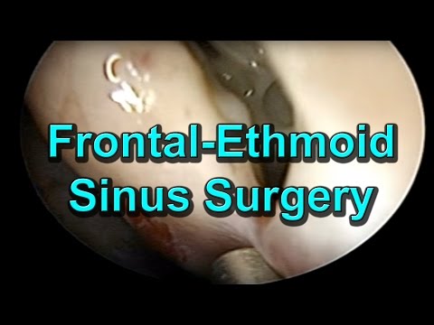 how to treat ethmoid sinusitis