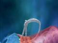 Neue minimal invasive Operation bei Wirbelsäulenfraktur