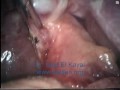 Laparoscopic Cholecystectomy in mirrizi syndrome