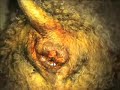 Adenoma glándulas hepatoides Adenoma glándulas hepatoides