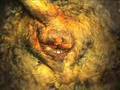 Adenoma glándulas hepatoides