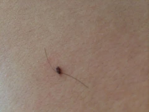 how to eliminate skin tags naturally