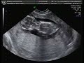 Bernardita Belen 12 semanas