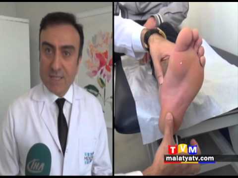 TOPUK DİKENİNDEN KISA SÜREDE KURTULABİLİRSİNİZ
