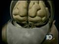 videos de WPLG - Miami Local 10 - Brain Surgery