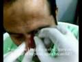 videos de Revolution of Treatment : Cupping therapy 
