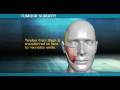videos de Tumour Surgery Medical Graphic