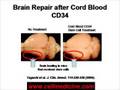 Stem Cell Therapy for Cerebral Palsy