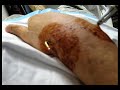 Wrist pins being removed, Orthopedic surgery