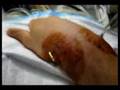 Wrist pins being removed, Orthopedic surgery