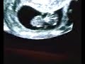 Ultrasound