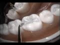 dental amalgam restoration