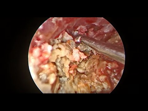 PAINFUL EAR INFECTION - EAR WAX REMOVAL - Dr Paul 2017